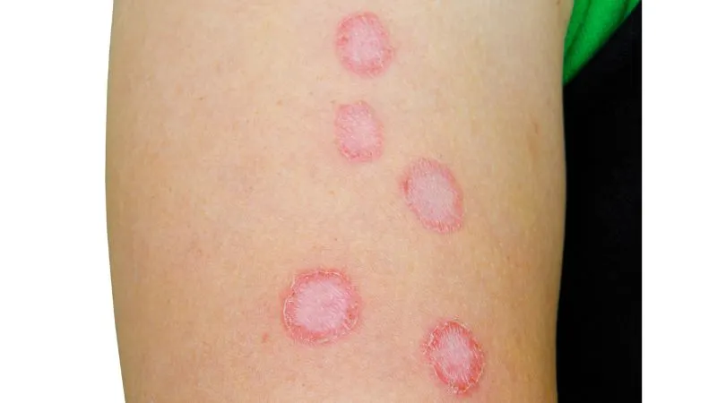 MICROSPORUM and TRICHOPHYTON INFECTIONS